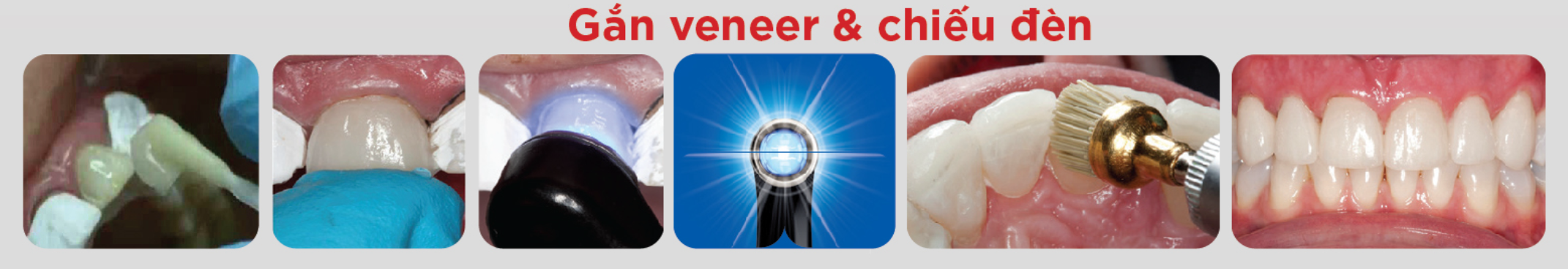 Các bước sử dụng bộ vật liệu gắn mặt dán sứ veneer của hãng Ultradent🌱NHA KHOA MALL🌱